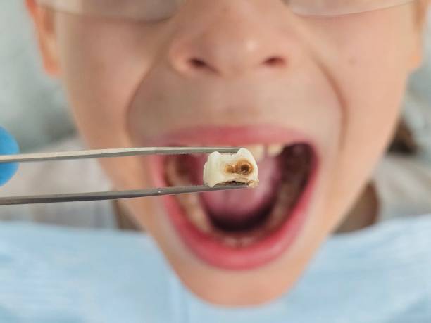Best Emergency Wisdom Teeth Removal in Kulpsville, PA